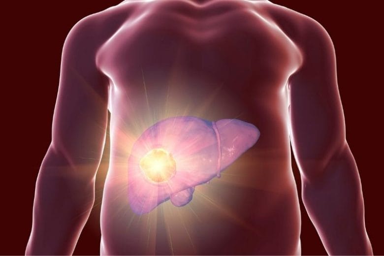 علاج سرطان الخلايا الكبدية