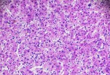 سرطان الخلايا الكبدية تحت المجهر